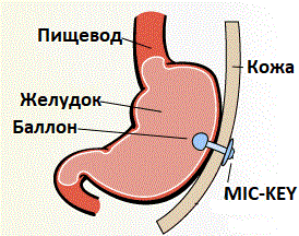 Kimberly-Clark Низкопрофильная гастростомическая питательная трубка, силикон. Фото N3