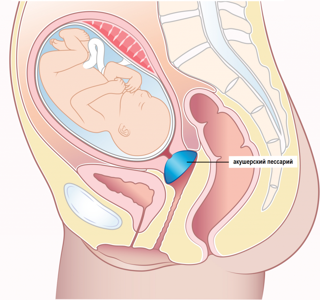 gynecology-obstetric-pessary.png