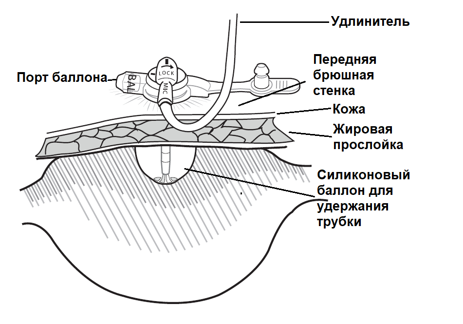 гастростома_схематично.png