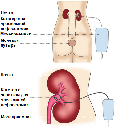 чрескожная нефростомия.png