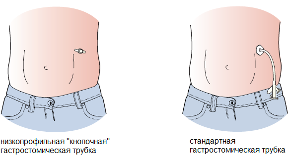 виды баллонных гастростом.png виды баллонных гастростом.png