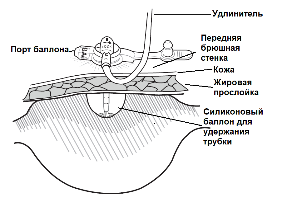 гастростома_схематично.png гастростома_схематично.png